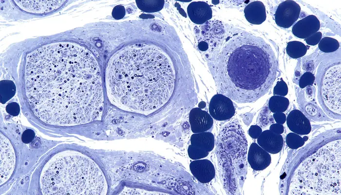 peripheral neuropathy image
